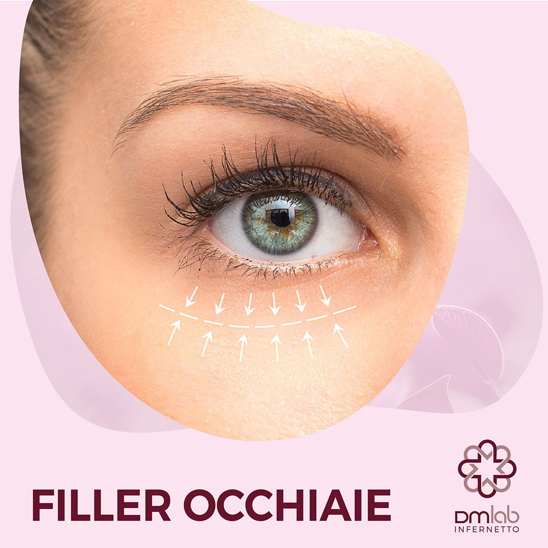 FILLER OCCHIAIE (Trattamento del Solco delle Occhiaie con Infiltrazioni di Acido Ialuronico a Basso Peso Molecolare)