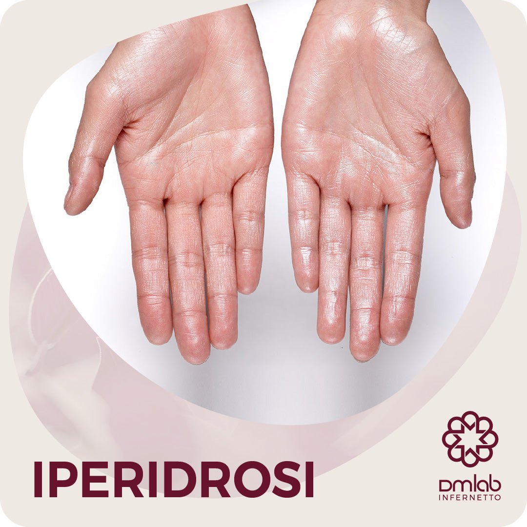 Trattamente IPERIDROSI con Tossina Botulinica